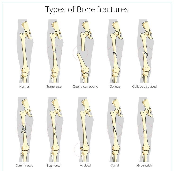 Understanding Different Types of Fractures and Their Treatments